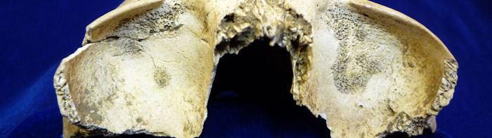A Bone to Pick: Basics of&nbsp;Palaeopathology